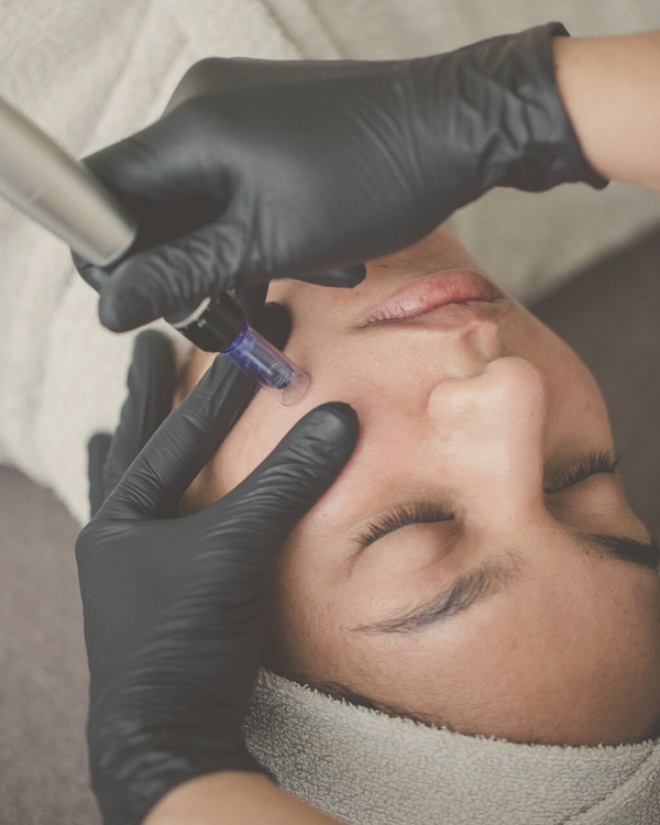 close-up of woman's face receiving a micro needling treatment