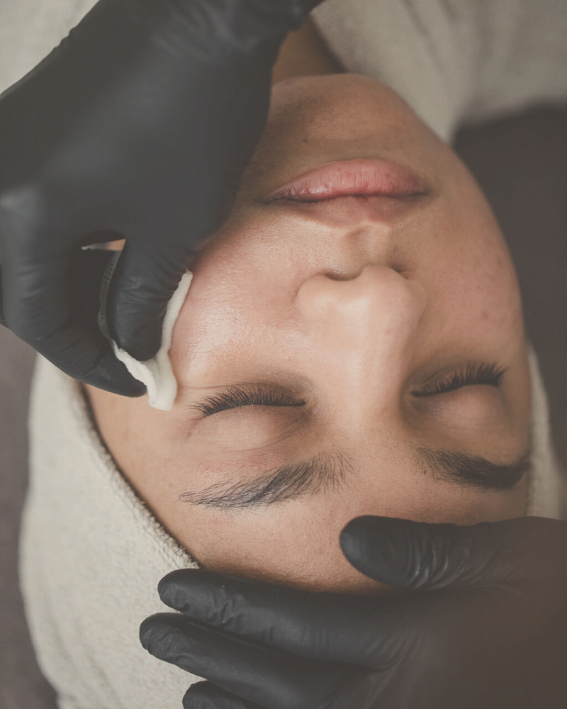 woman receiving a holistic and natural Skin Health Peel